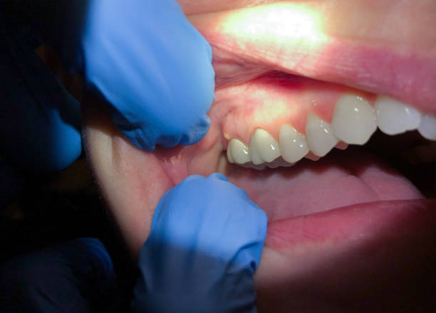 Best Emergency Dental Care for Broken or Chipped Teeth in Valle Vista, AZ